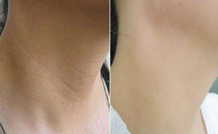 嗨體去頸紋效果怎么樣？