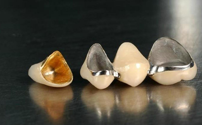 全瓷烤瓷牙多少錢一顆2021？全瓷牙可以用多久？