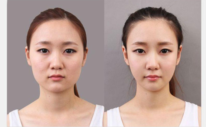 手術(shù)瘦臉大概多少錢？