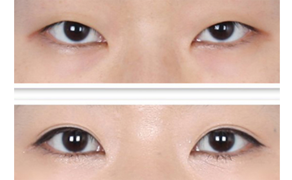 瞼松弛矯正適應癥是什么?術后怎么護理?