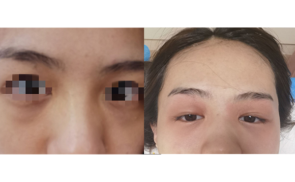 光子嫩膚去黑眼圈怎么樣？