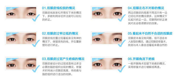 雙眼皮修復(fù)手術(shù)成功率高嗎？雙眼皮修復(fù)的最佳時(shí)間