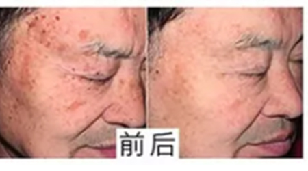 華韓醫(yī)療美容醫(yī)院祛斑案例對(duì)比
