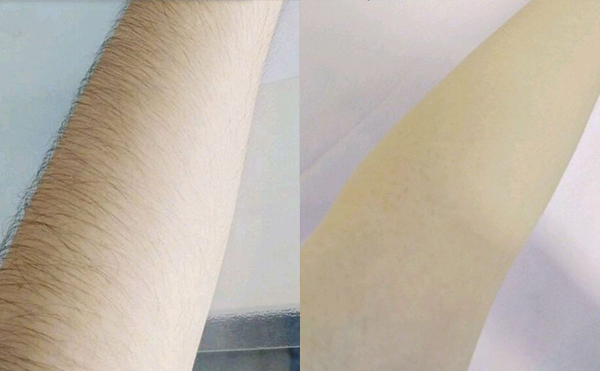 光子脫毛有疼痛感嗎？