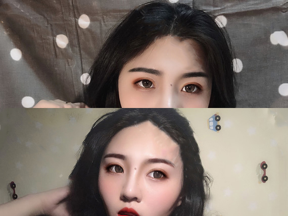 雙眼皮手術(shù)恢復(fù)效果2