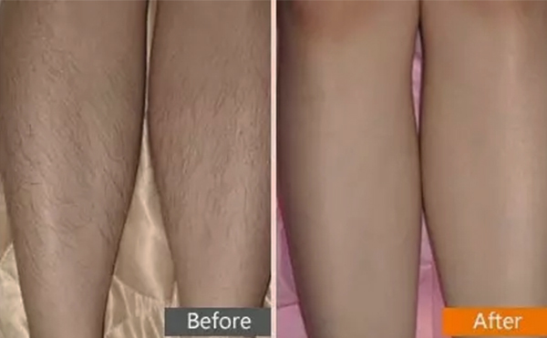 彩光脫毛是什么原理?有什么特點(diǎn)?