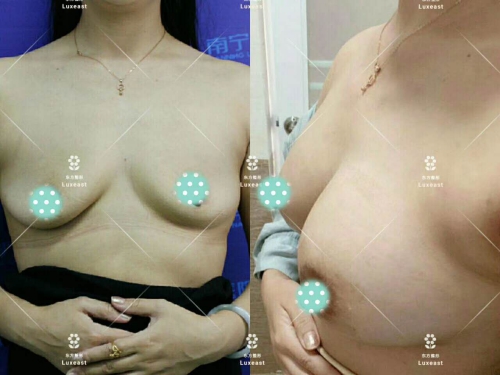 松弛胸部矯正效果