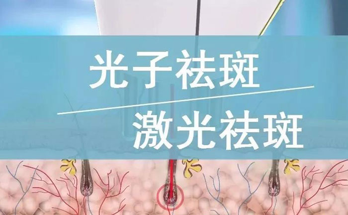 光子祛斑效果如何？
