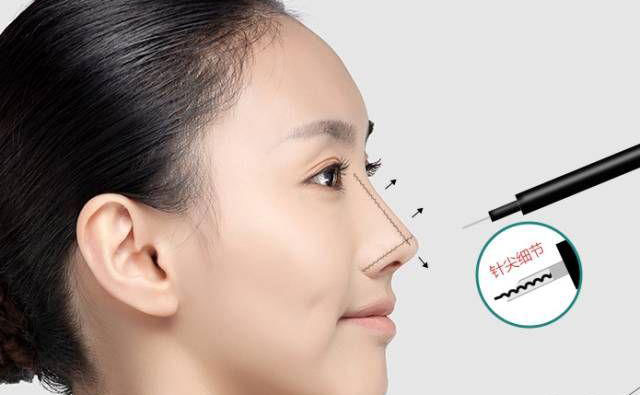 鼻部除皺的最好方法是什么？鼻部除皺多少錢？