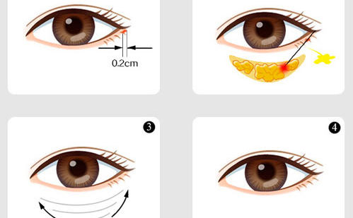 內(nèi)切眼袋怎么做？