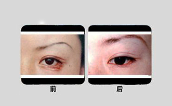眼瞼外翻手術(shù)步驟是什么?有什么優(yōu)勢(shì)?