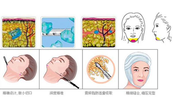 下巴整形吸脂術(shù)要多少錢？