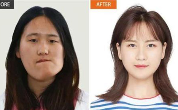 磨骨瘦臉有幾種手術(shù)方法?磨骨瘦臉禁忌人群