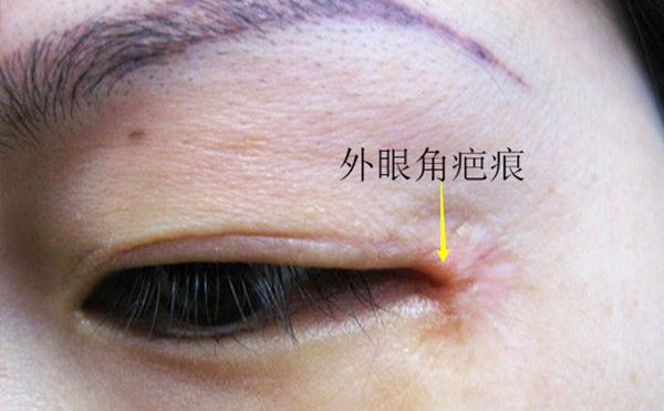 開外眼角有什么后遺癥?開外眼角效果明顯嗎?