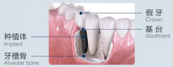 美奧口腔牙齒種植技術(shù)