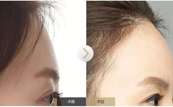 額頭填充術(shù)可以保持多久？