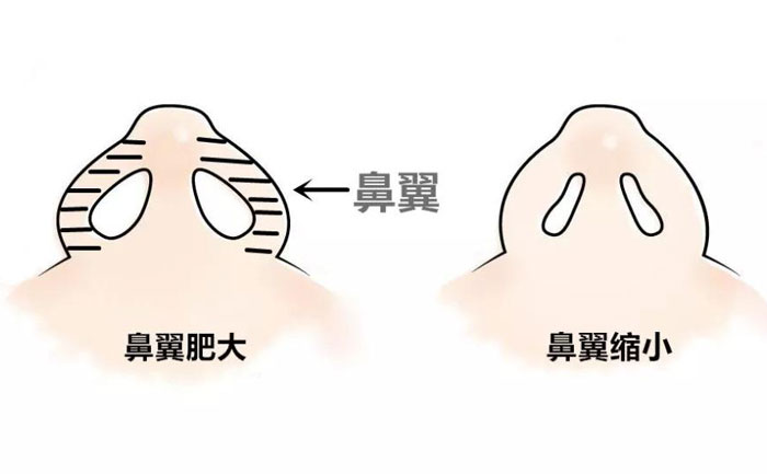 鼻翼縮小手術要做多久？