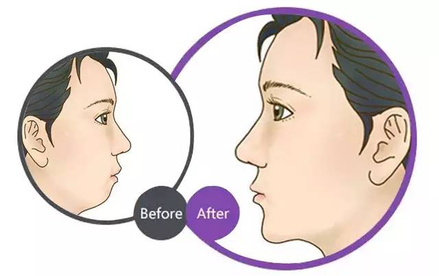 下巴突出是什么原因引起的？