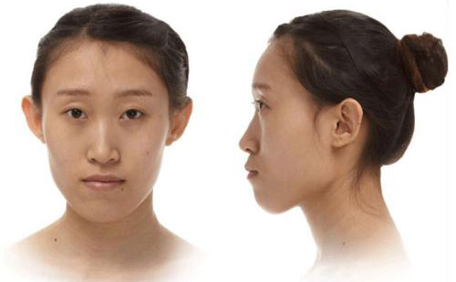 下巴突出是什么原因引起的？下巴突出側(cè)面很難看怎么矯正？