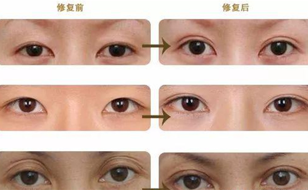 雙眼皮修復可靠嗎？什么時候做雙眼皮修復比較好？