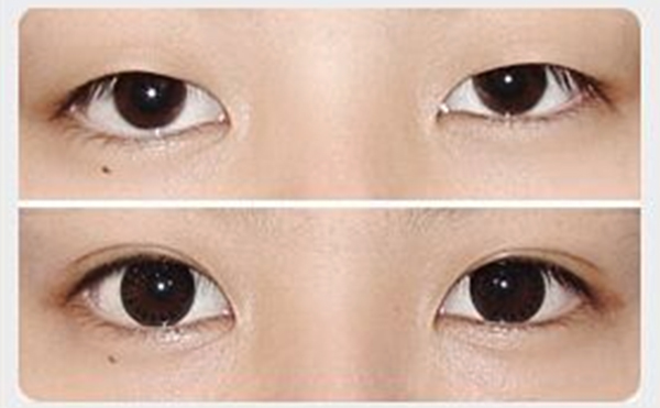 割雙眼皮和開眼角可以同時進行嗎?一共多少錢?