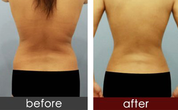 背部吸脂手術(shù)的過程是什么？