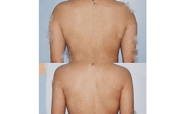 背部吸脂安全嗎？