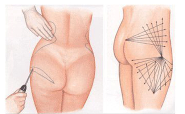 臀部吸脂的手術(shù)過(guò)程是什么？