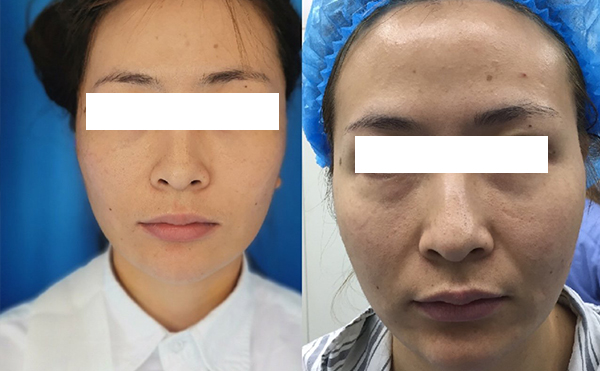 拉皮和線雕哪個(gè)效果好？