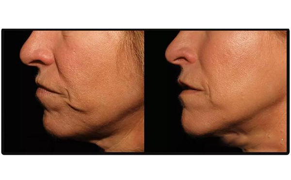 電波拉皮安全嗎？