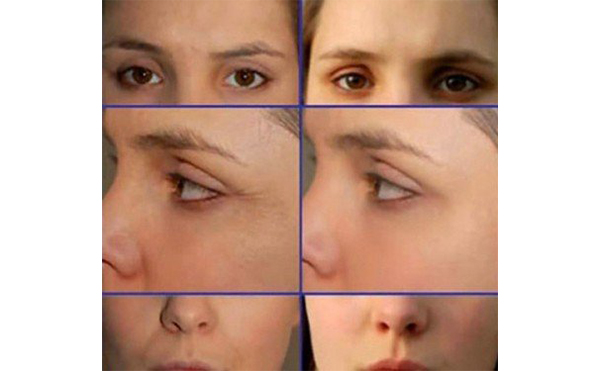 電波拉皮適合哪些人？