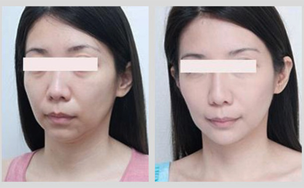 激光除皺是什么原理？