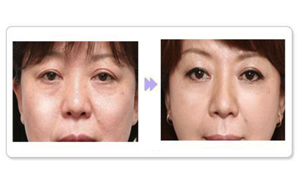 除皺針適合哪個(gè)年齡段？