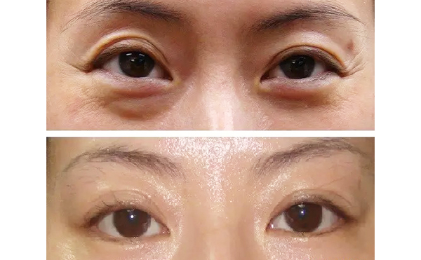 魚尾紋是怎么引起的？