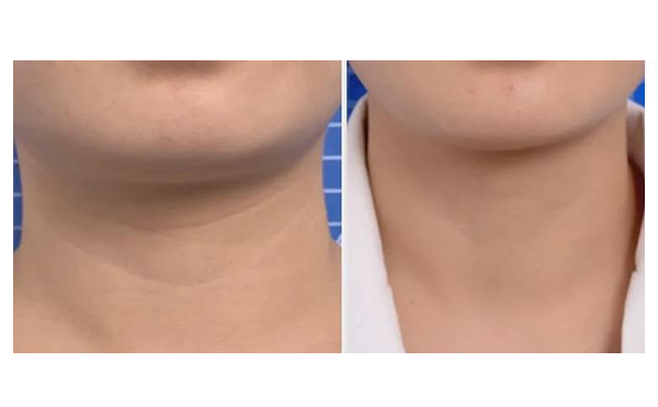 頸紋是怎么形成的？