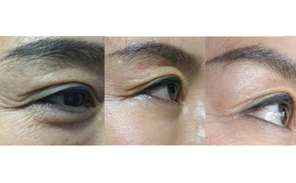 膠原蛋白除皺是什么原理？