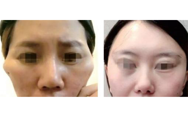 筋膜懸吊除皺有什么副作用？