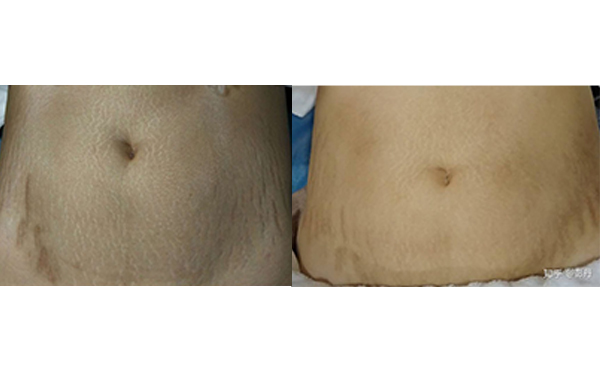 激光去妊娠紋有哪些優(yōu)勢？