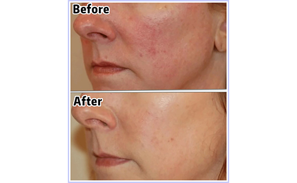 光子嫩膚會(huì)讓皮膚變薄嗎？