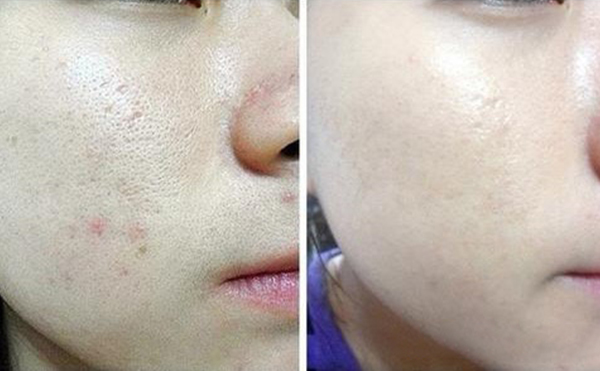 光子嫩膚的過程是什么？