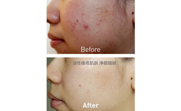 果酸煥膚能維持多久？