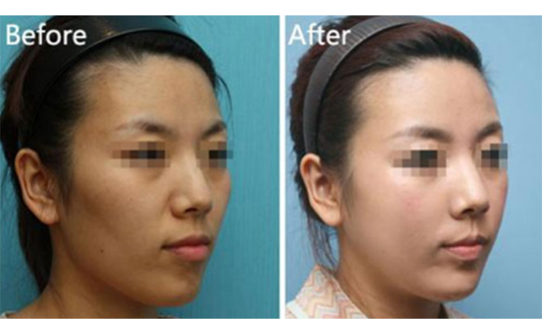 美白針一針多少錢？