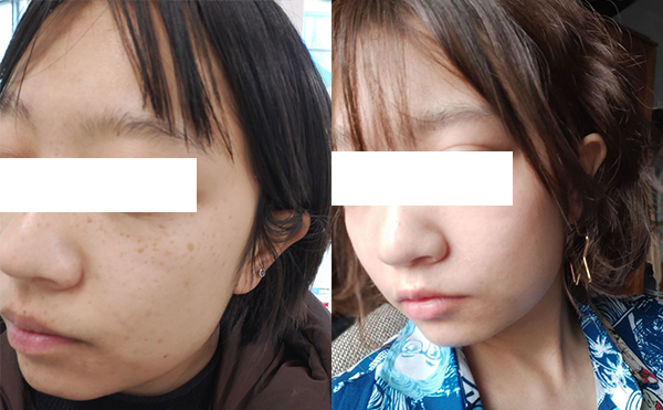 激光祛斑效果好不好？