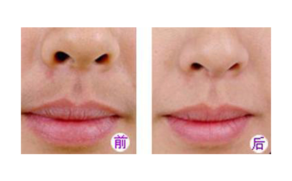 冰點脫毛好不好？