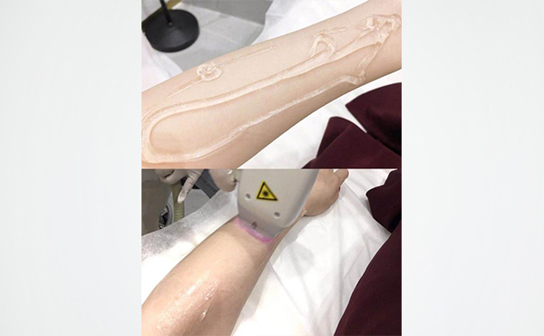 激光手臂脫毛是怎么做的？