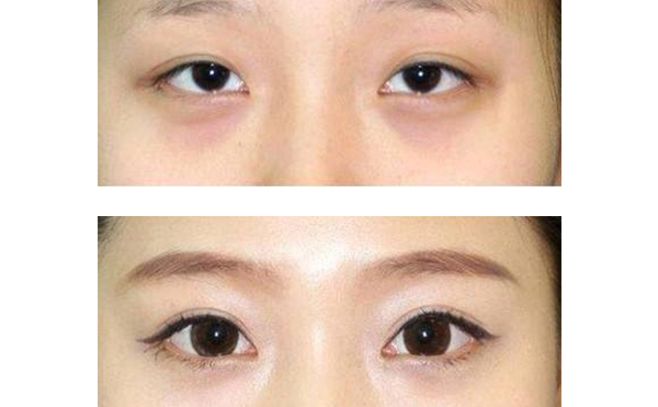 眼綜合和隆鼻可以一起做嗎？