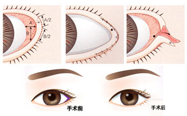 開外眼角和眼瞼下至的區(qū)別是什么?多久恢復好?