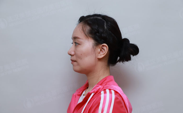 顴骨突出怎樣改善？