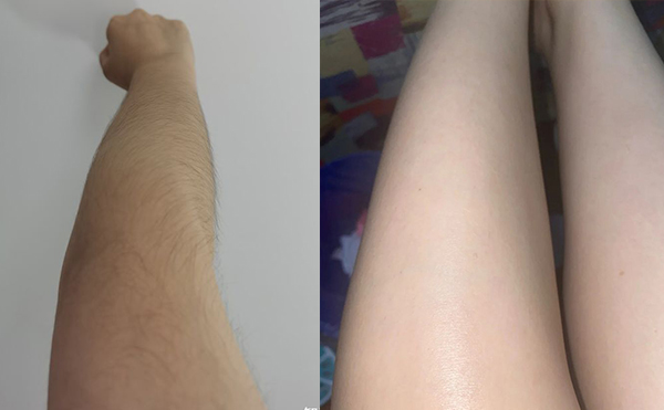 【術(shù)前必看】激光手臂脫毛六大注意事項(xiàng)!