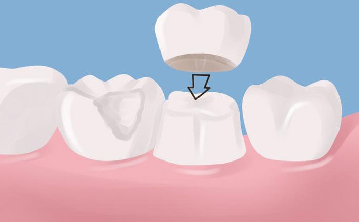 牙冠修復(fù)后能堅(jiān)持幾年？